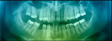 what does a cavity look like on an x ray