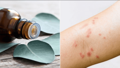 essential oils for hives