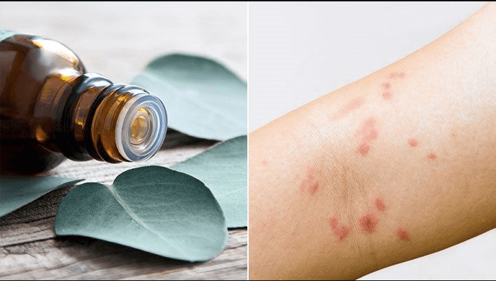 essential oils for hives