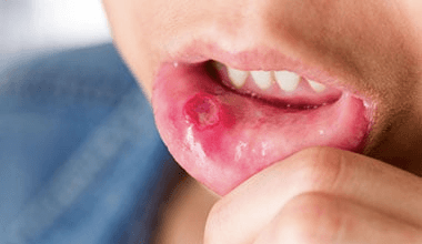 difference between mouth ulcer and cancer
