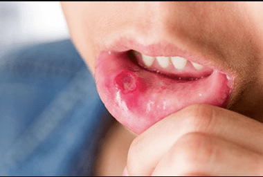 difference between mouth ulcer and cancer