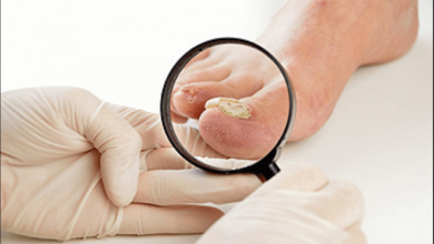 is toenail fungus contagious
