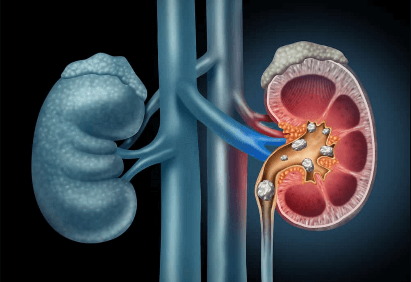 The Painful Truth: Exploring the World's Largest Kidney Stone