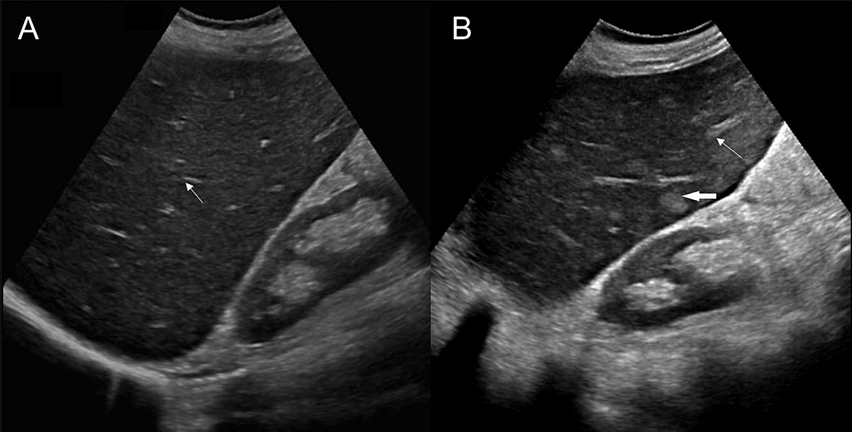 ultrasound-imaging-adenomyosis-uterus