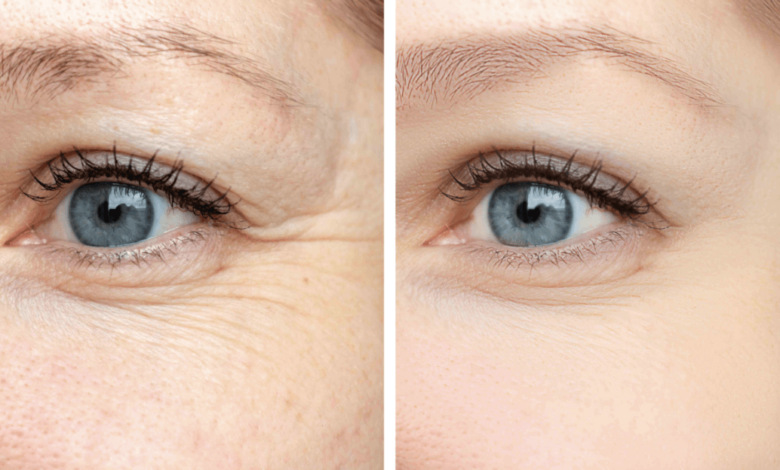 botox around eyes before and after