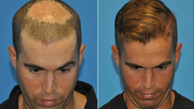 hair transplant infection