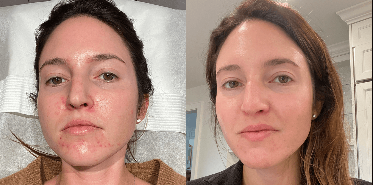 How Long Does Chemical Peeling Last: A Comprehensive Guide