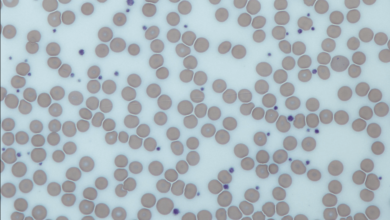 can stress cause low platelets