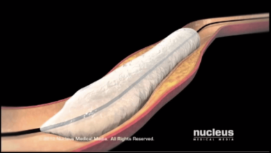 percutaneous transluminal angioplasty