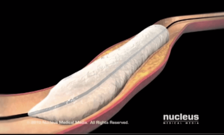 percutaneous transluminal angioplasty