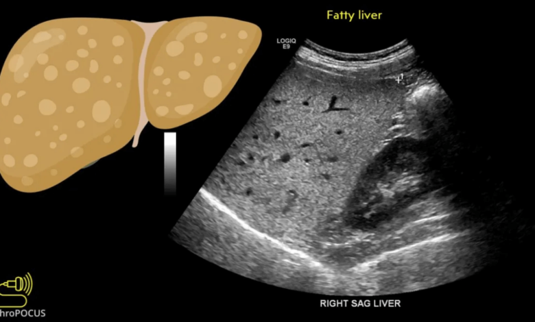 echogenic parenchyma