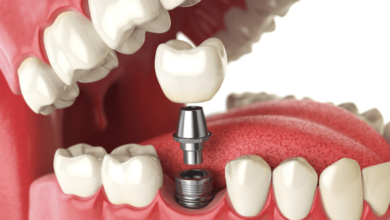 average cost of a dental implant