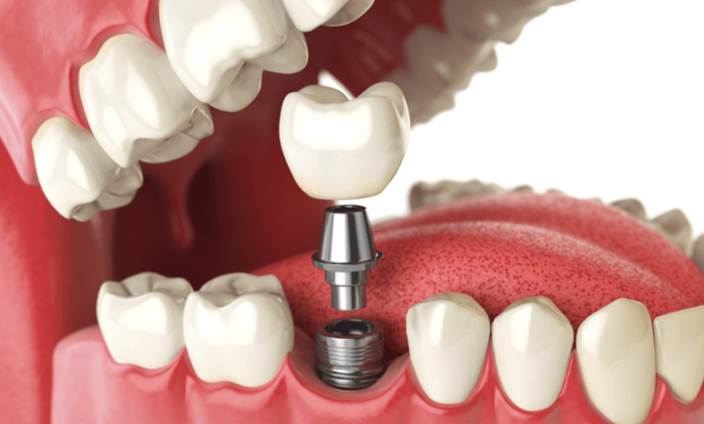 average cost of a dental implant