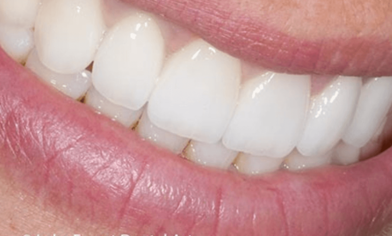 dental bridge front teeth before and after