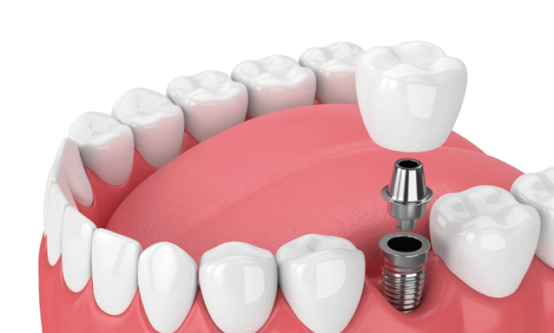 free dental implants for low income