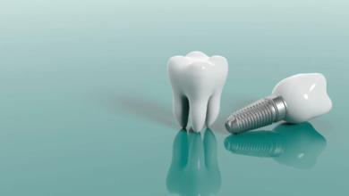 are dental implants worth it