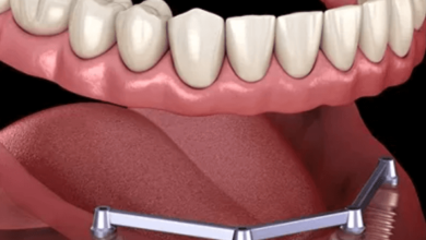 cost of dental implant
