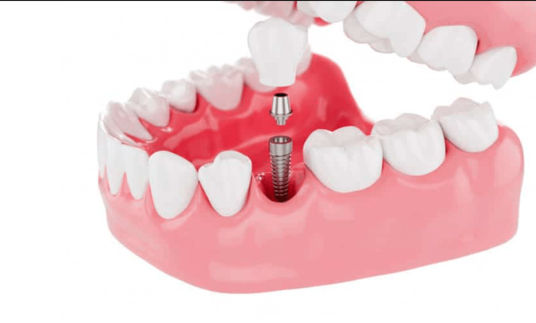 low cost dental implants