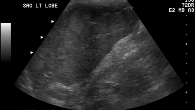 normal liver size ultrasound