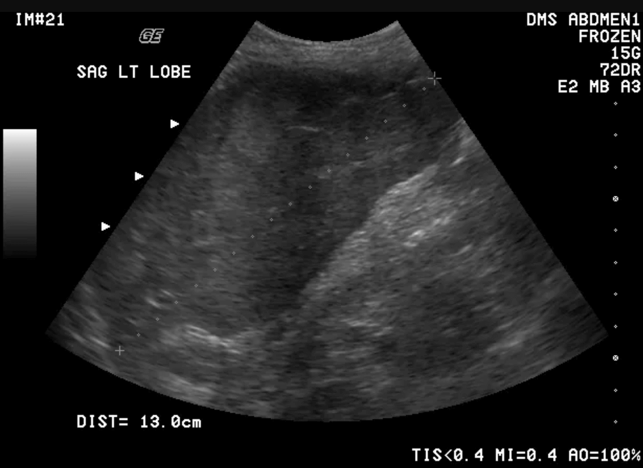 normal-liver-size-ultrasound-a-comprehensive-guide