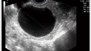 ovarian cyst ultrasound pictures