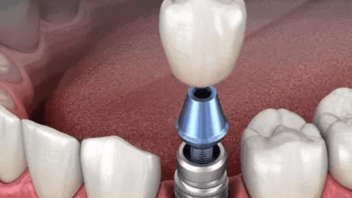 price for dental implants