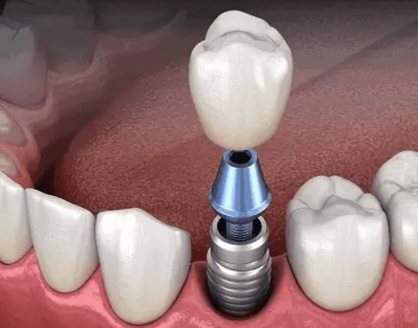 price for dental implants