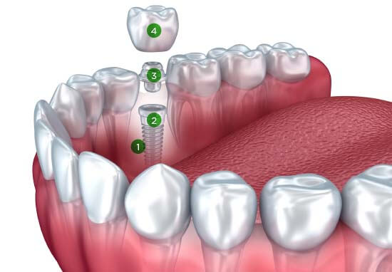 delta dental implant coverage