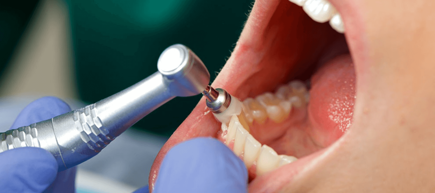 Learn All About Dental Cleaning Without Insurance