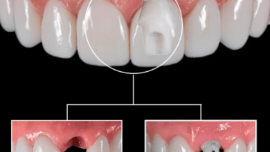 dental implants in mexico