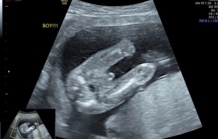 how early can gender be determined by ultrasound