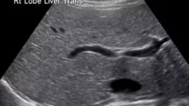 spot on liver ultrasoun