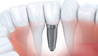 cuanto cuesta un implante dental