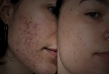 Shah Hassan Ch’s Revolutionary Acne Pitted Scars Treatment