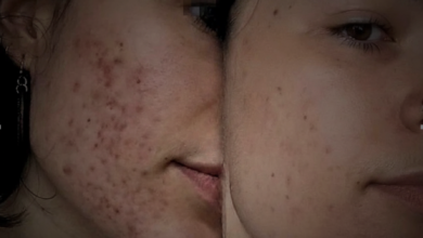Shah Hassan Ch’s Revolutionary Acne Pitted Scars Treatment