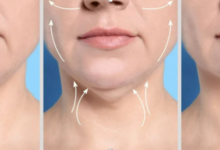 Dermal Filler Longevity: What Influences Your Results