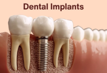 Why Dental Implants Are a Popular Solution for Missing Teeth