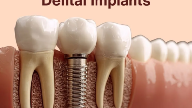 Why Dental Implants Are a Popular Solution for Missing Teeth