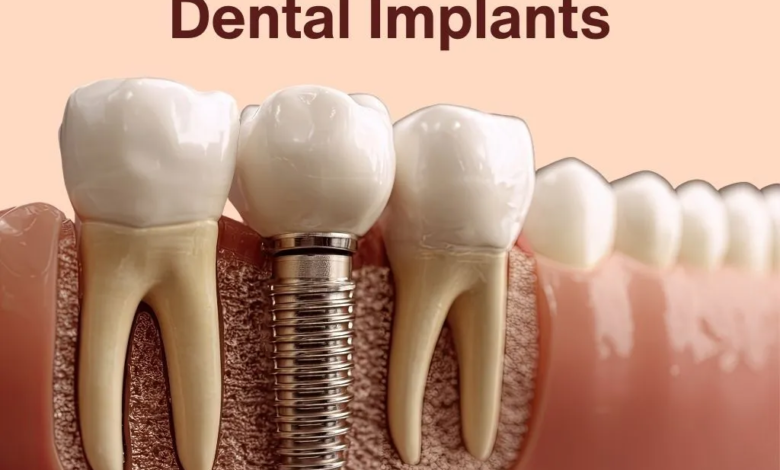 Why Dental Implants Are a Popular Solution for Missing Teeth