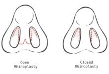 Rhinoplasty Abroad: What to Expect Before, During and After