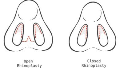 Rhinoplasty Abroad: What to Expect Before, During and After