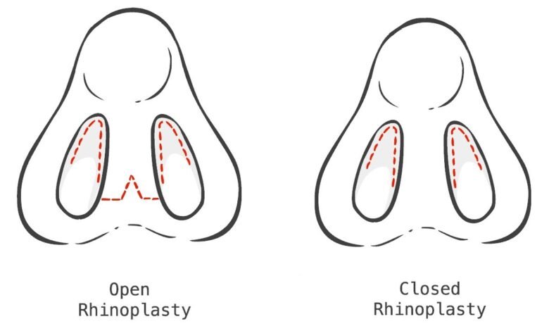 Rhinoplasty Abroad: What to Expect Before, During and After